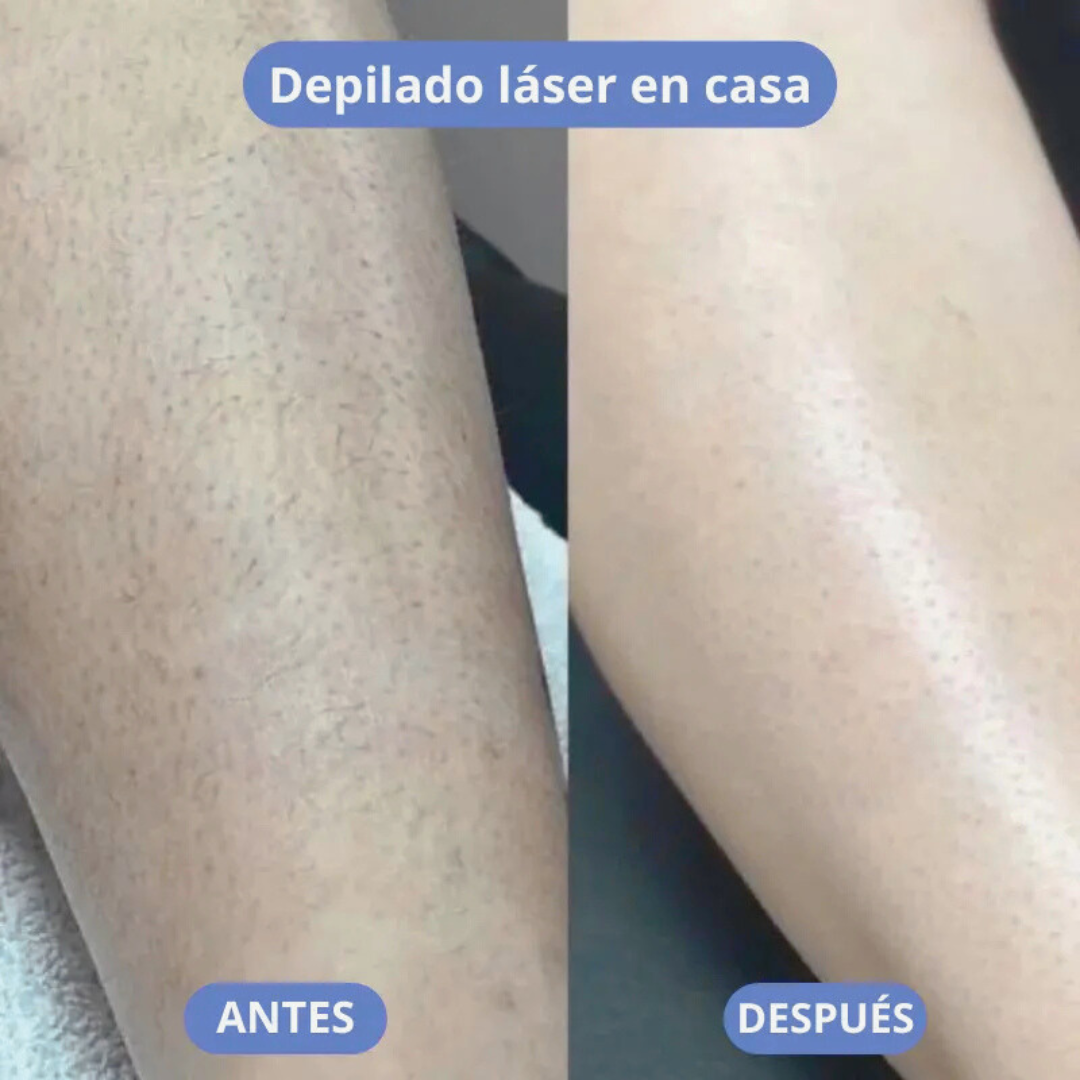 Xentinnel® Depiladora Láser